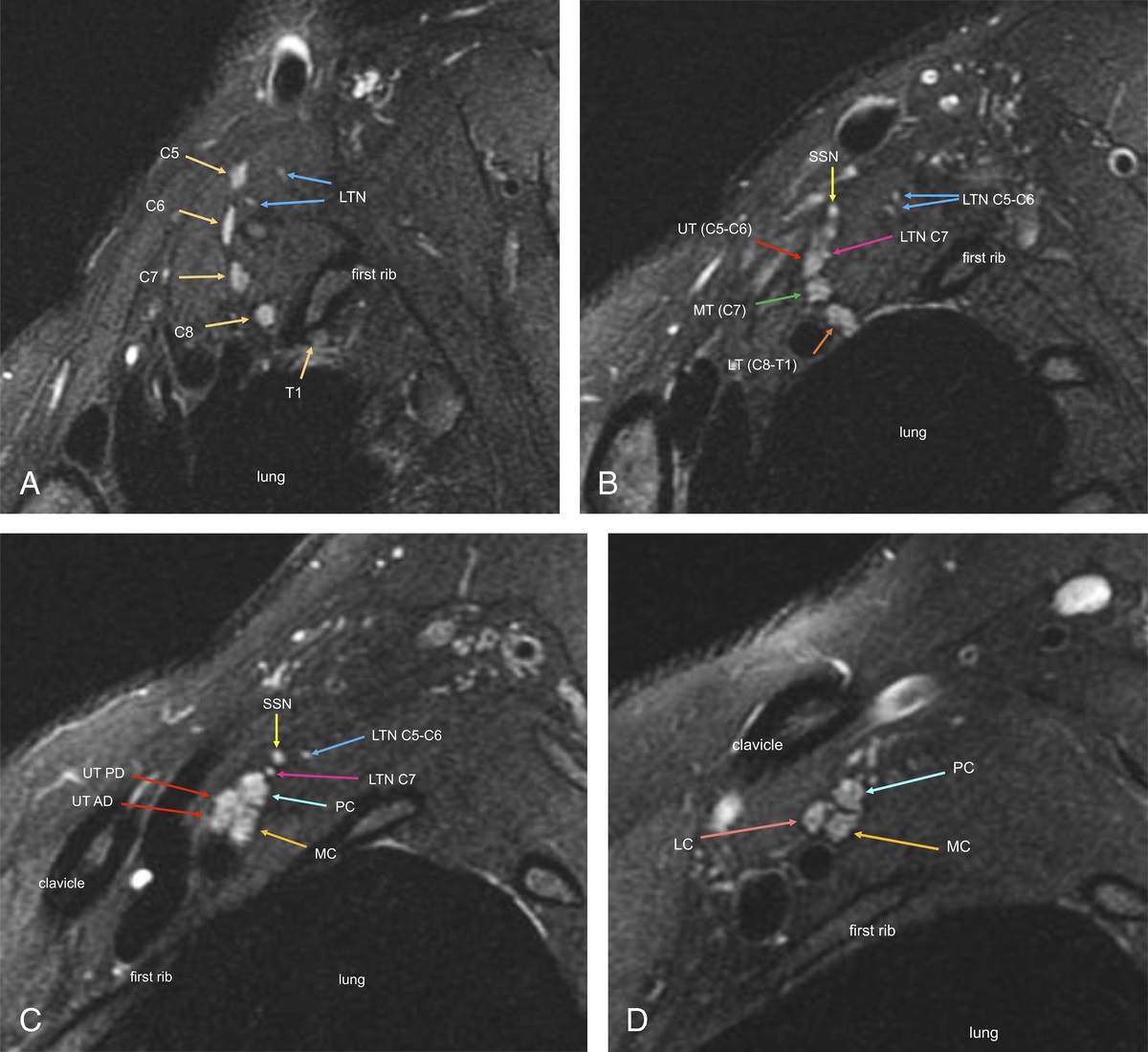 Brachial Plexus Magnetic Resonance Neurography: Technical Challenges and Solutions