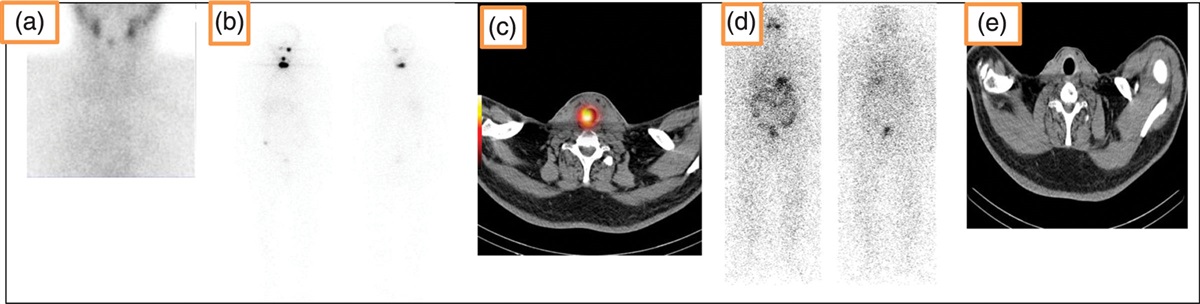The prognostic value of post thyroidectomy Tc-99m pertechnetate thyroid scan in patients with differentiated thyroid cancer