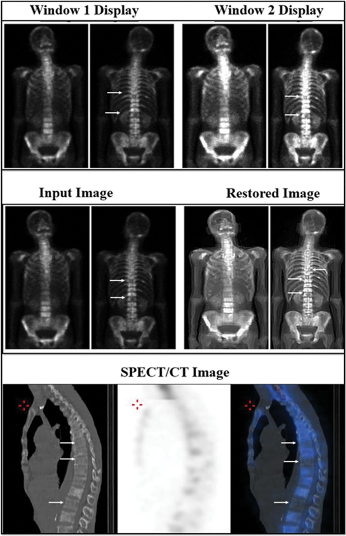Vertebral and ribs enhancement in Tc-99m methylene diphosphonate bone scan image by blind deconvolution algorithm