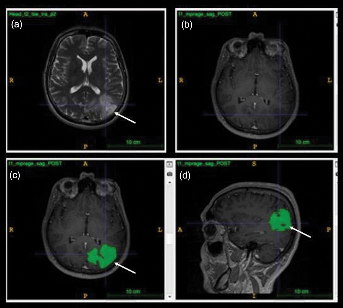 Mapping glioma heterogeneity using multiparametric 18F-choline PET/MRI in childhood and teenage-young adults