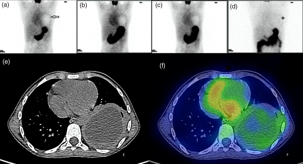 Multi-time point imaging in 99mTc-pertechnetate scintigraphy of ectopic gastric mucosa in duplication cysts: value-added services