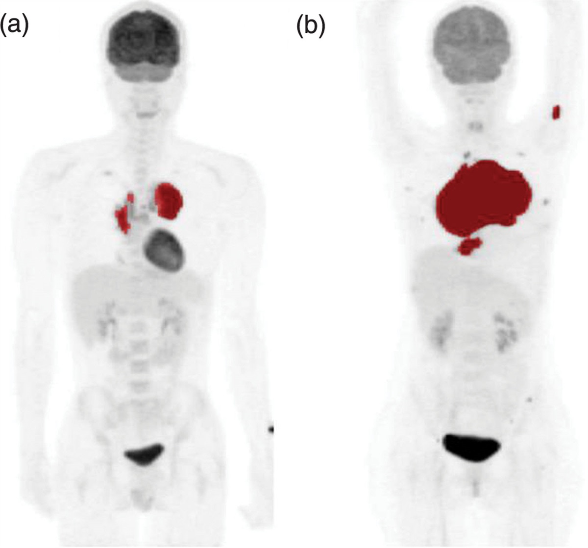 Influence of the methodological aspects of the dichotomization of total metabolic tumor volume measured through baseline fluorine-18 fluorodeoxyglucose PET on survival prediction in lymphoma
