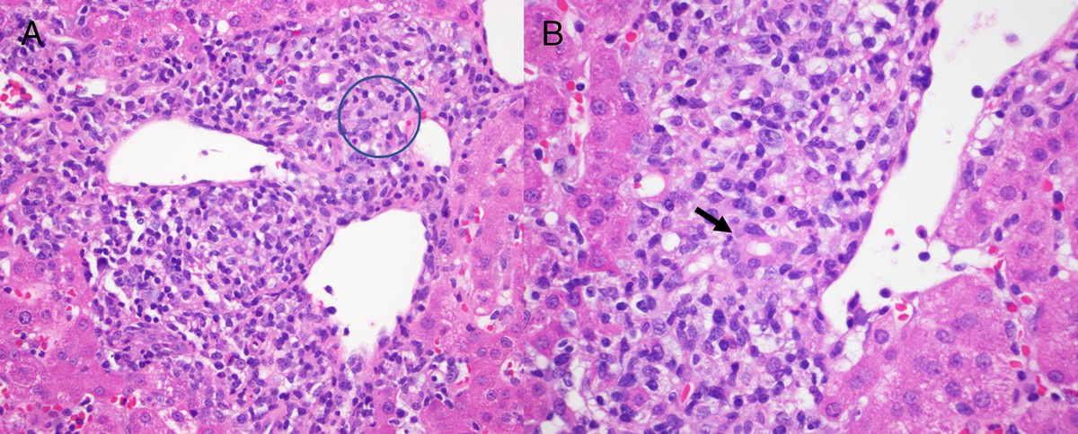 Hemophagocytic Lymphohistiocytosis: A Practical Review for Liver Pathologists