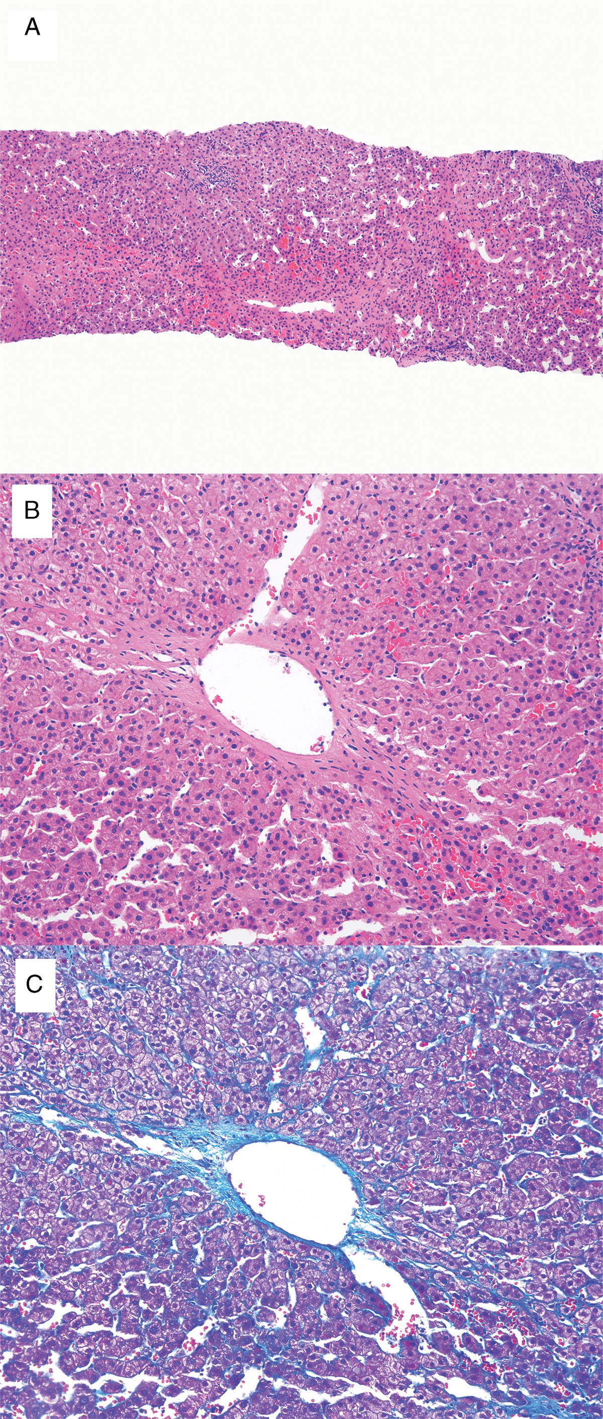 Congestive Hepatopathy: A Case of Fontan-Associated Liver Disease and Review of Literature