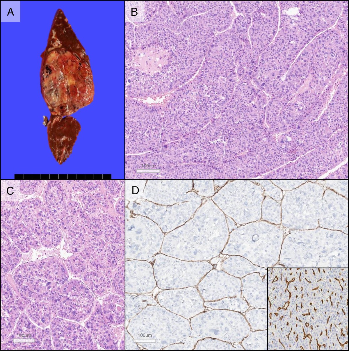 Histomorphological Subtypes of Hepatocellular Carcinoma and Intrahepatic Cholangiocarcinoma: Review and Update