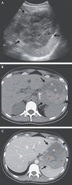 Case 39-2022: A 31-Year-Old Woman with Postpartum Abdominal Pain and Fever