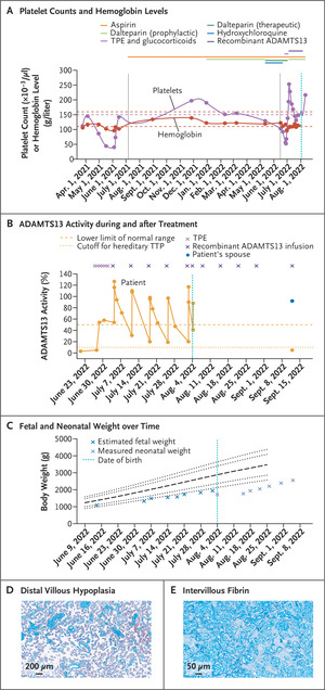 Recombinant ADAMTS13 for Hereditary Thrombotic Thrombocytopenic Purpura