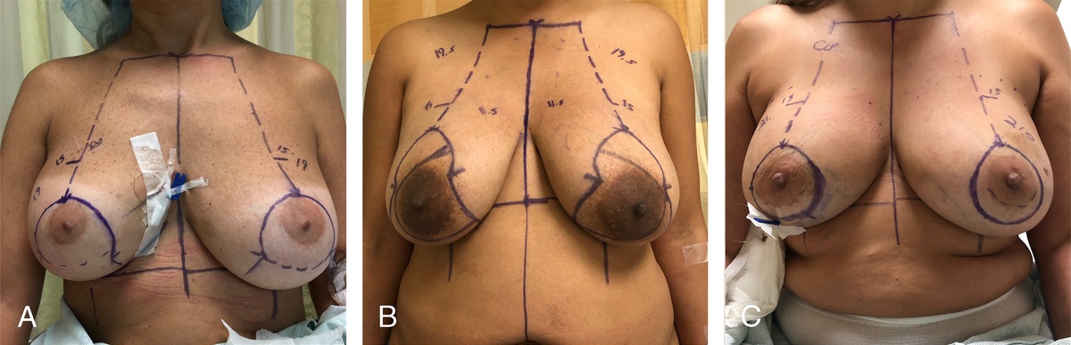 Oncoplastic Augmentation Mastopexy in Breast Conservation Therapy: Retrospective Study and Postoperative Complications