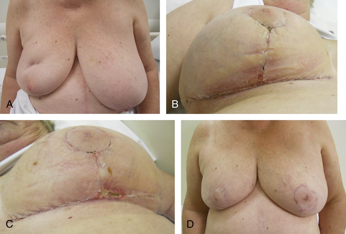 Safety of Reduction Mammaplasty and Mastopexy After Breast Conservation Therapy and Radiation Therapy: A Case Series