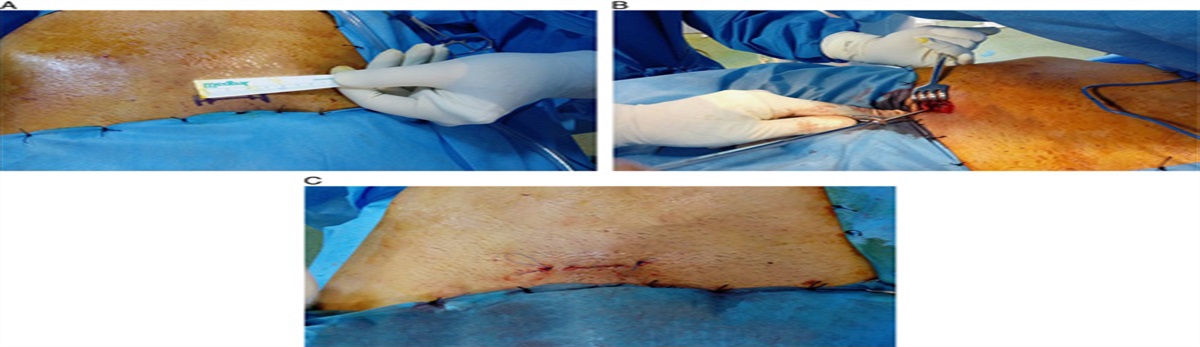 A New Technique for Anterior Pelvic Ring Fixation Using a Minimally Invasive Approach