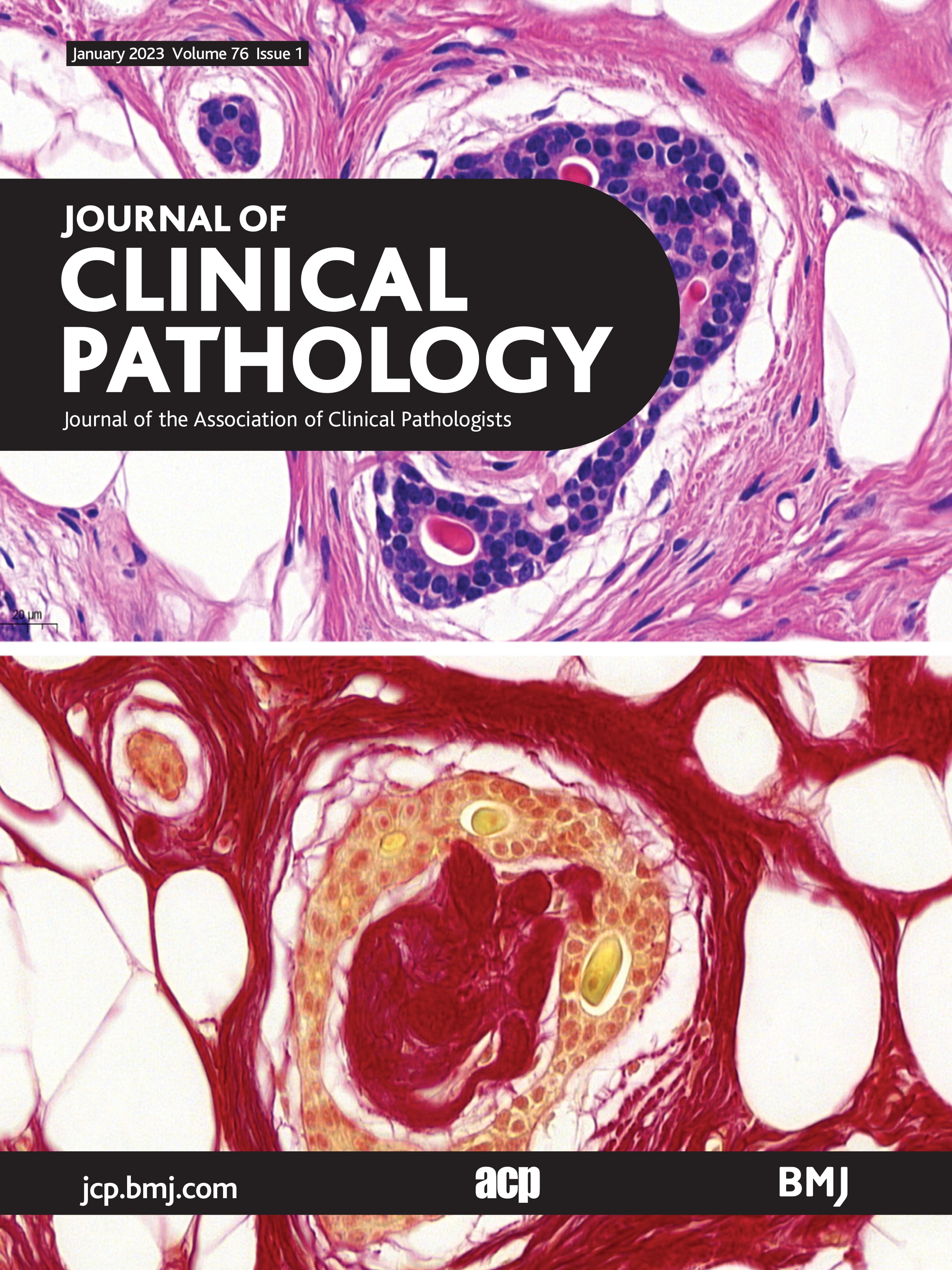 Potential pitfalls in multiplex PCR-based next-generation sequencing: a case-based report
