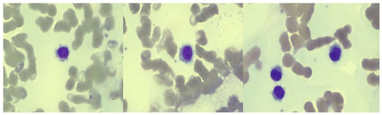 JCM, Vol. 12, Pages 193: A Frail Hairy Cell Leukemia Patient Successfully Treated with Pegylated Interferon-α-2A