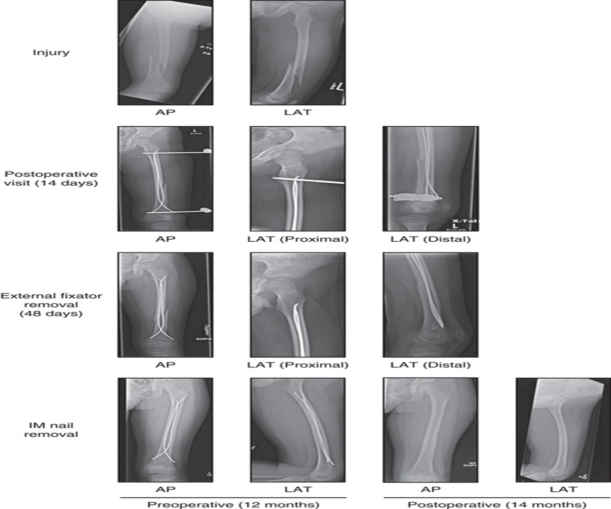 Flexible Intramedullary Nail Fixation With Supplemental External Fixator for Unstable Pediatric Femur Fractures: A Case Series