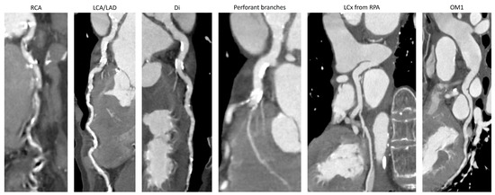 JCM, Vol. 12, Pages 226: CT Detection of an Anomalous Left Circumflex Coronary Artery from Pulmonary Artery (ALXCAPA) in 81-Year-Old Female Patient