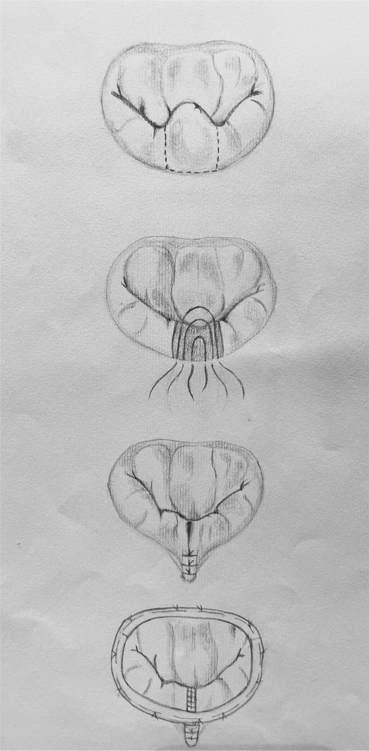 A journey from resect to respect to restore: aiming at optimal physiological surgical mitral valve repair