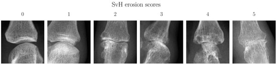 Diagnostics, Vol. 13, Pages 104: Adaptive IoU Thresholding for Improving Small Object Detection: A Proof-of-Concept Study of Hand Erosions Classification of Patients with Rheumatic Arthritis on X-ray Images