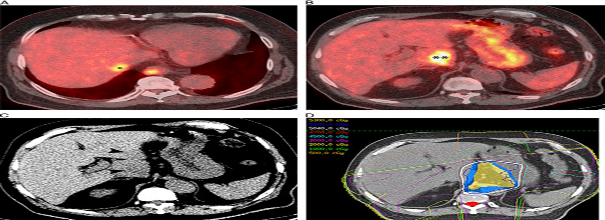 Liver Injury in Patients With Distal Esophageal Carcinoma After Precision Radiation Therapy: Systematic Review of FDG-PET/CT Patterns