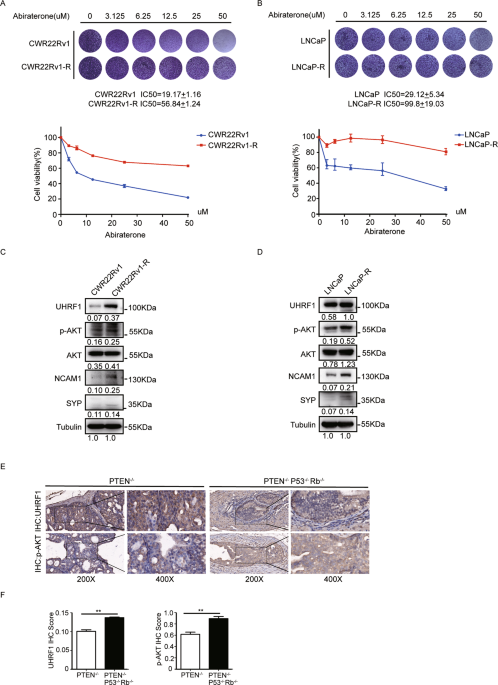 AKT1 regulates UHRF1 protein stability and promotes the resistance to abiraterone in prostate cancer