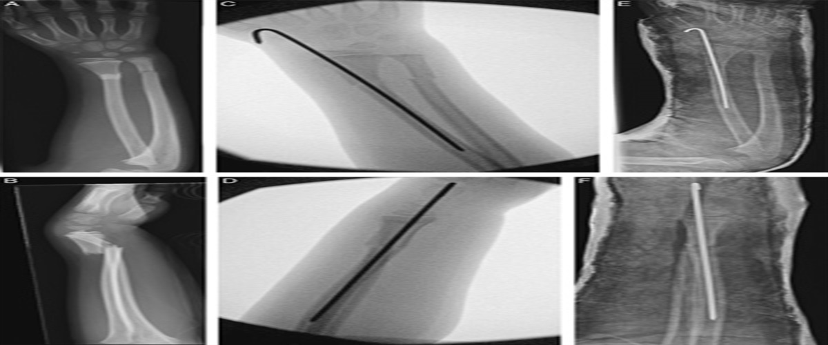A Cost-effective Technical Tip for Surgical Management of Pediatric Distal Radius and Ulna Fractures at Metadiaphyseal Junction
