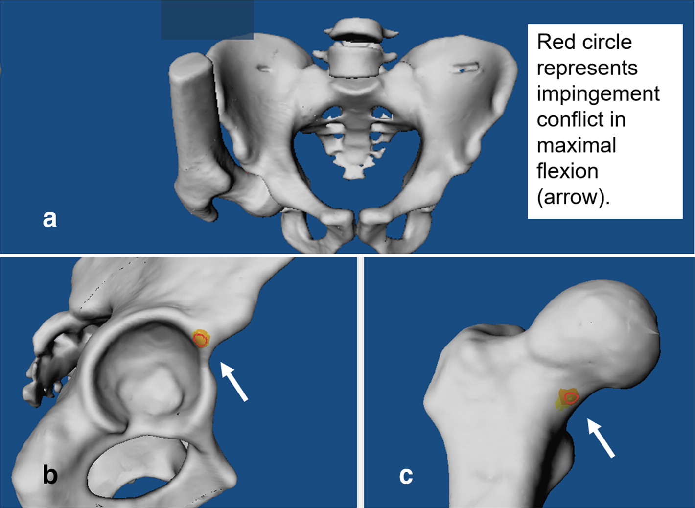 Femoral impingement in maximal hip flexion is anterior-inferior distal to the cam deformity in femoroacetabular impingement patients with femoral retroversion