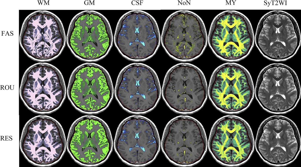 Clinical Feasibility of Automated Brain Tissue and Myelin Volumetry of Normal Brian Using Synthetic Magnetic Resonance Imaging With Fast Imaging Protocol: A Single-Center Pilot Study