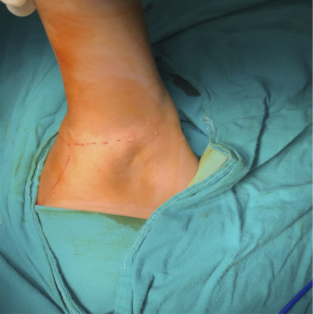 Comparing the Results of Latissimus Dorsi Versus Teres Major Transfer in Children With Obstetric Brachial Plexus Injury and Residual Shoulder Sequelae