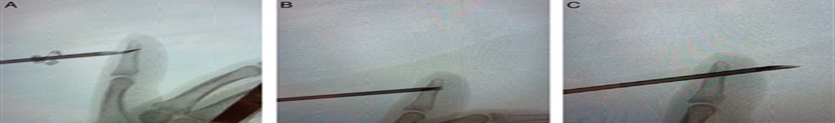 Percutaneous Removal of a Foreign Body From the Distal Phalanx Using a 14 Gauge Needle and Fluoroscopy