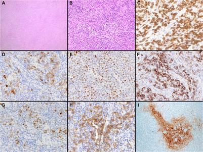 Pathologic and molecular insights in nodal T-follicular helper cell lymphomas