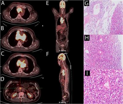 Relapsed/refractory diffuse large B cell lymphoma with cardiac involvement: A case report and literature review