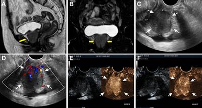 A rare case of IgG4-related disease masquerading as periurethral malignancy and review of the literature