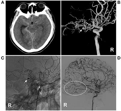 Parent artery occlusion for ruptured aneurysms in moyamoya vessels or on collaterals