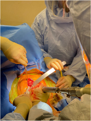 Emerging Technologies in Shoulder Arthroplasty