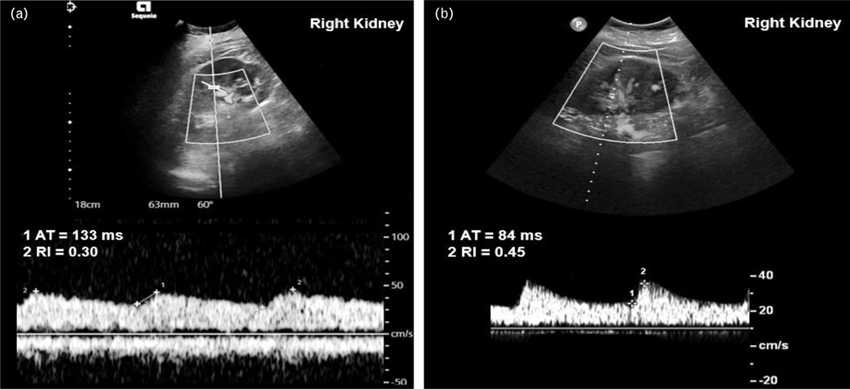 How acute renal failure led to the diagnosis of aortic coarctation