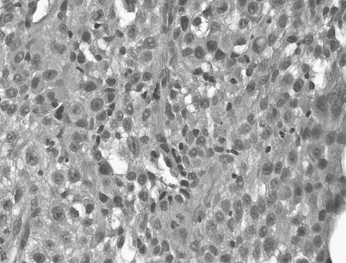 Treatment of metastatic alveolar soft part sarcoma with axitinib and pembrolizumab in an 80-year-old patient with a history of autoimmune disorders