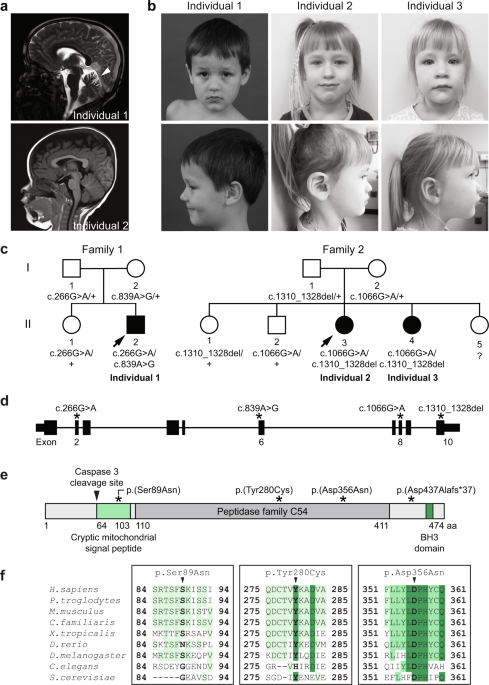 Bi-allelic ATG4D variants are associated with a neurodevelopmental disorder characterized by speech and motor impairment