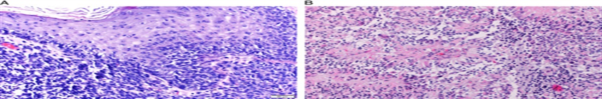 Melanoma and Glioblastoma—Not a Serendipitous Association