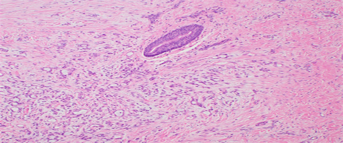 Microsecretory Adenocarcinoma of Salivary Glands