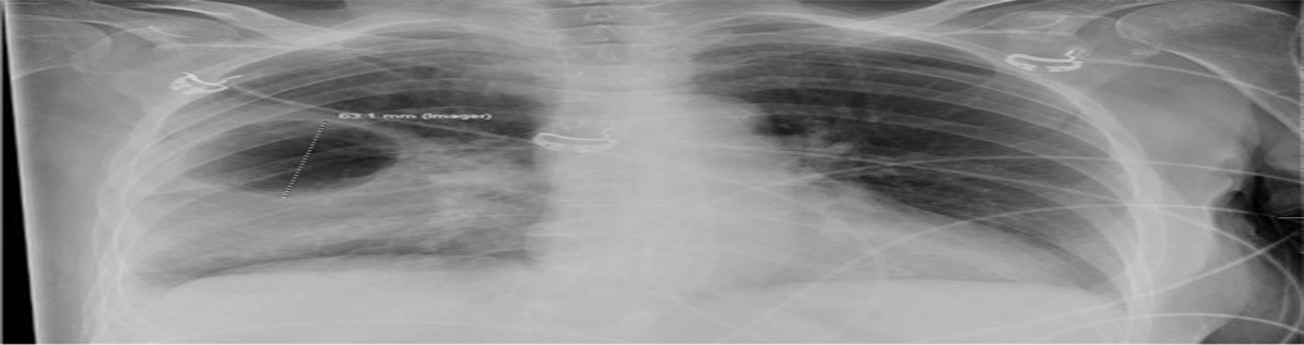 An Unexpected Finding on Chest Radiograph: Cavitating Pneumonia