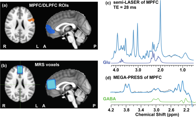 Association of default-mode network neurotransmitters and inter-network functional connectivity in first episode psychosis