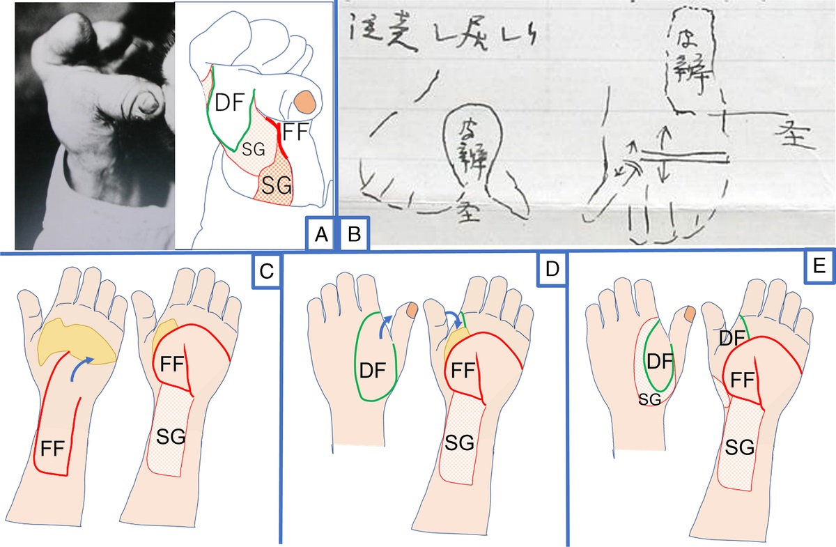 Tsugishige Kondo, The Father of Japanese Surgery: Exploring the History of Hideyo Noguchi's Hand Reconstruction With a Forearm Flap Before the Establishment of Plastic Surgery in Japan