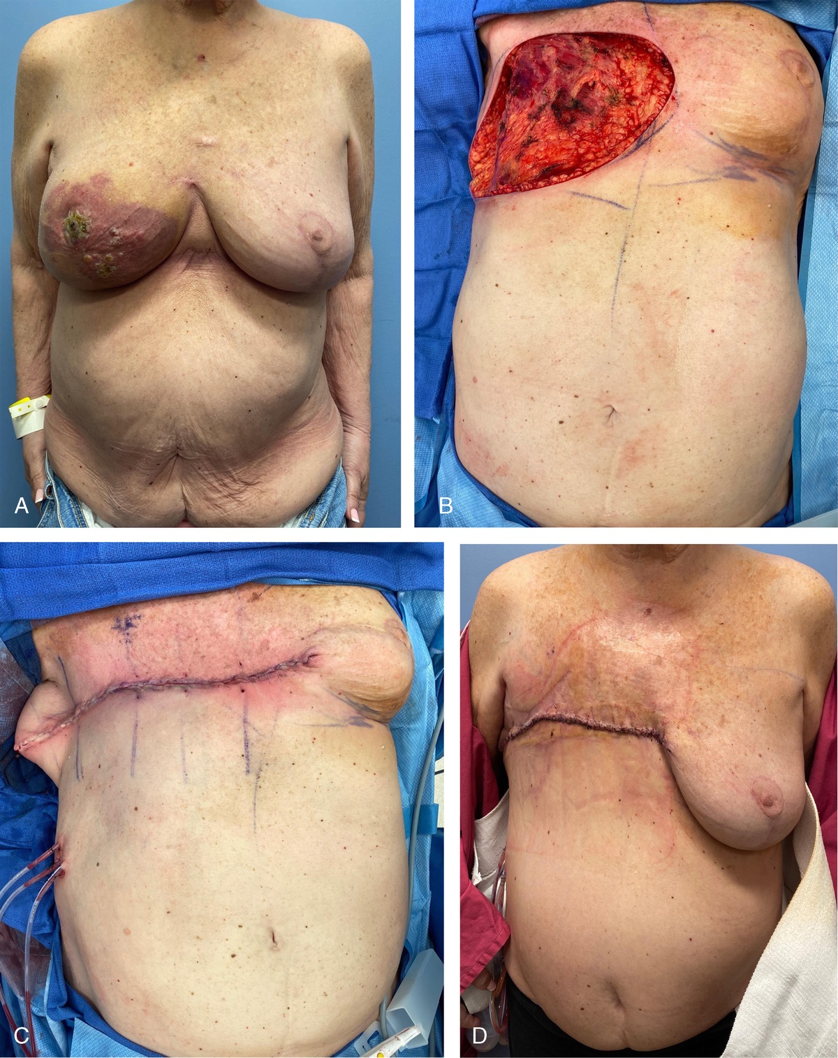 Reverse Abdominoplasty for Mastectomy Defect Closure in Advanced Breast Cancer