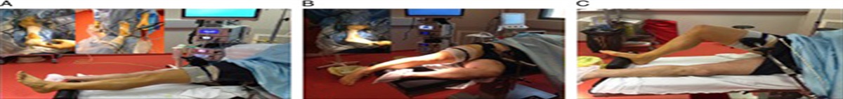 Endoscopic Approach to Ligament Repair and Reconstruction for Chronic Ankle Instability
