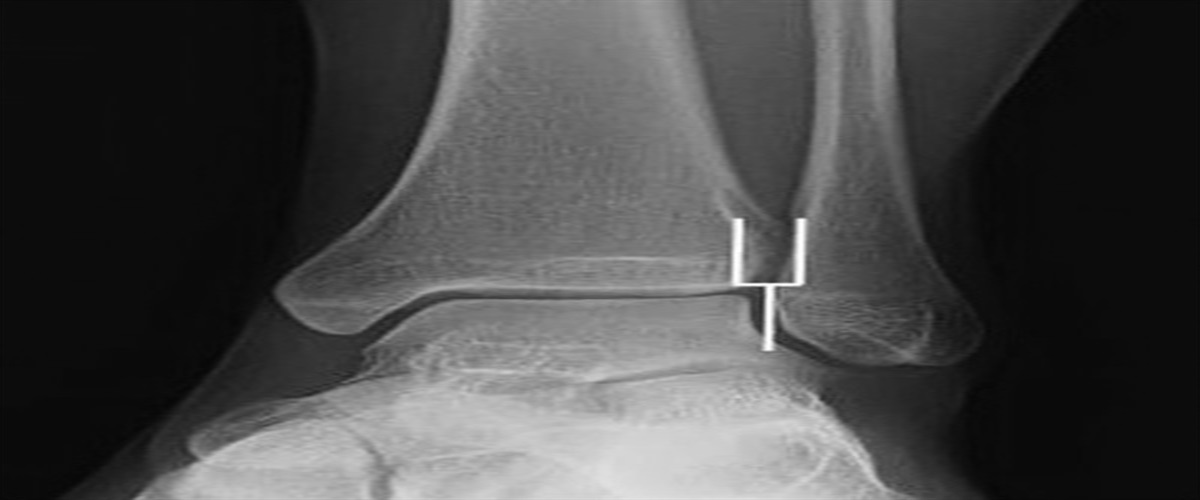 “Sonanis Tuning Fork Lines”: A New Radiologic Method to Determine Talar Shift, Diastasis, and Displacement of Lateral Malleolus in Ankle Fractures