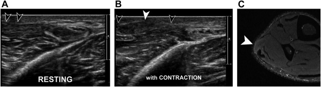 Imaging of Muscle Injuries