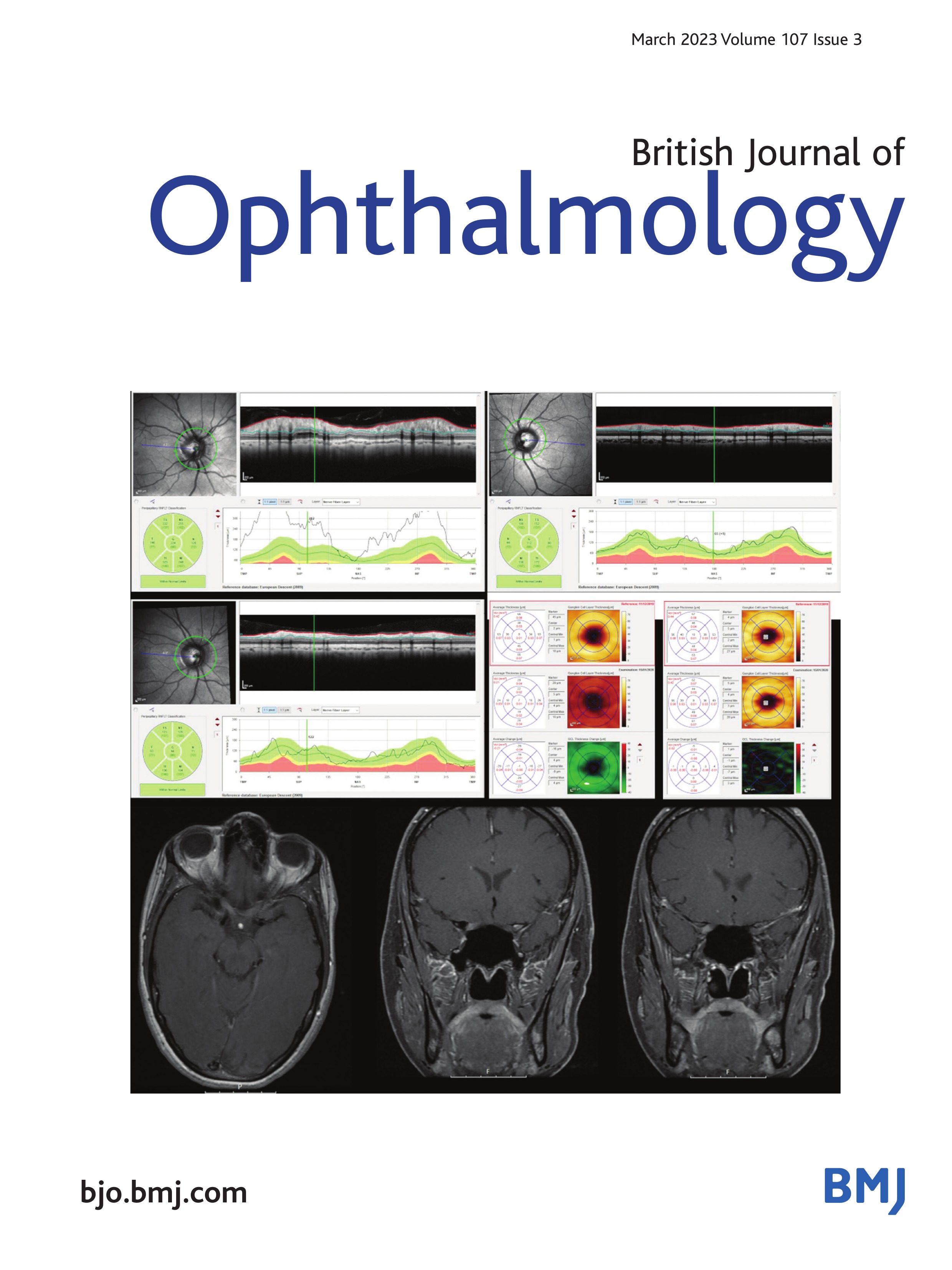 Evaluation of blood vessel network formation and visual field defect in optic disc melanocytoma