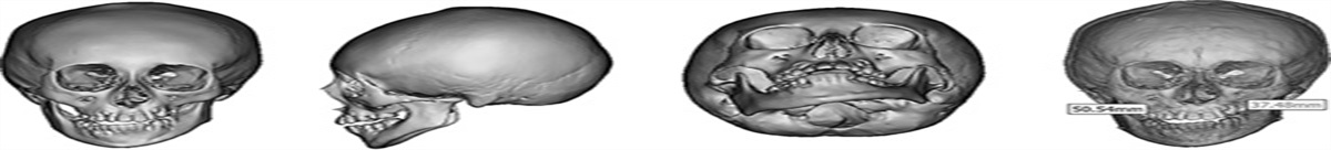 Exploration of Novel Genetic Evidence and Clinical Significance Into Hemifacial Microsomia Pathogenesis