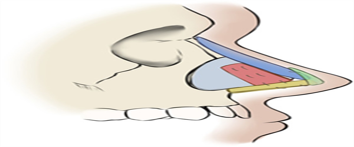 Autologous Costal Cartilage With Expanded Polytetrafluorethylene (ePTFE) Implants for the Treatment of Nasal Deformity After Unilateral Cleft Lip Repair