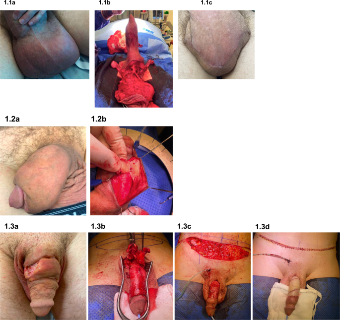 Complications and outcomes following injection of foreign material into the male external genitalia for augmentation: a single-centre experience and systematic review