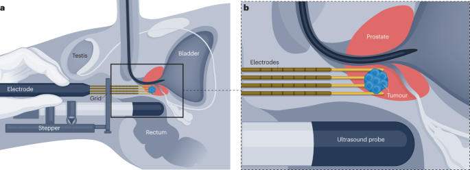 Salvage irreversible electroporation for radio-recurrent prostate cancer