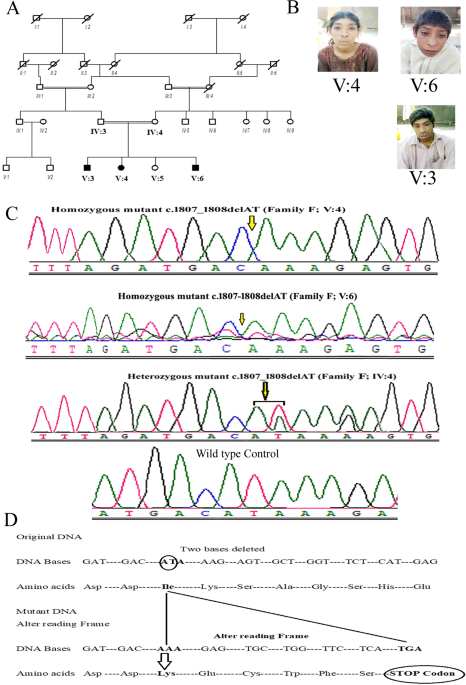 Recurrence mutation in RBBP8 gene causing non-syndromic autosomal recessive primary microcephaly; geometric simulation approach for insight into predicted computational models